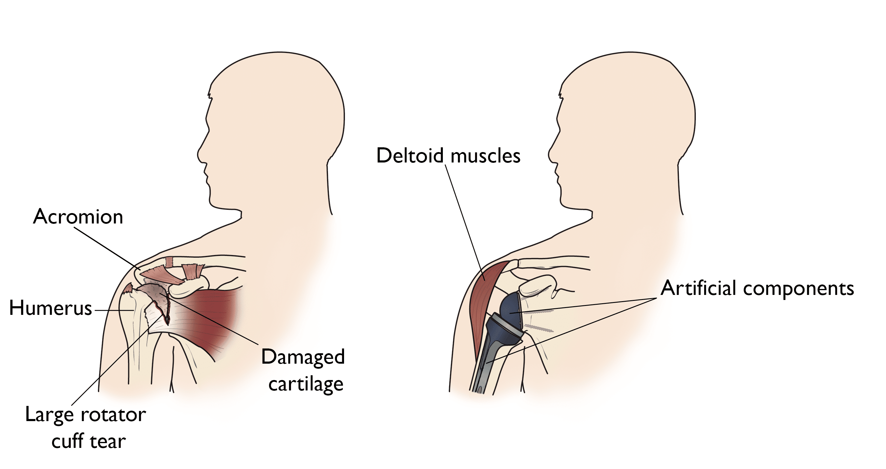 Shoulder joint replacement