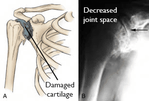 Shoulder anatomy